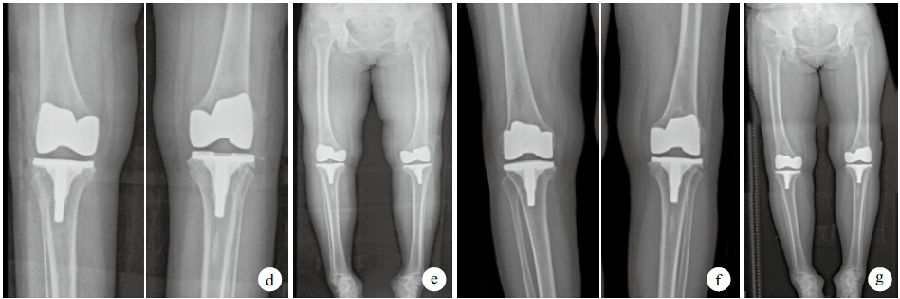 a 术前双膝关节正位x线片 b 术前双下肢全长x线片 c 术中缩小胫骨平台