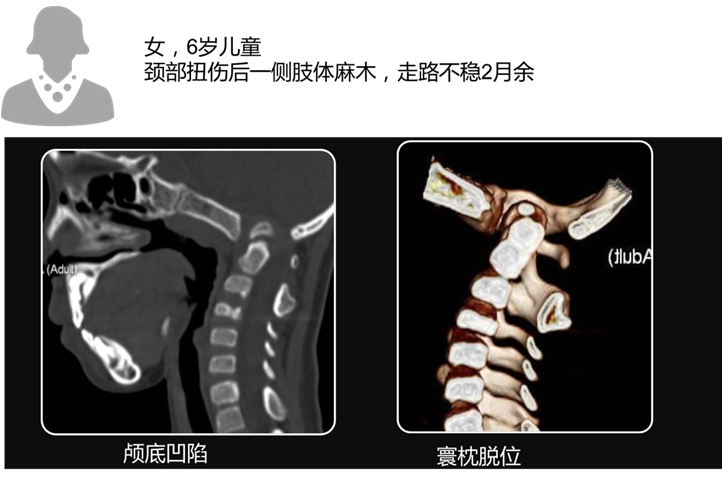 颅底陷入症图片