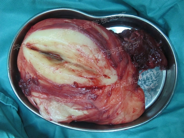脂肪肉瘤晚期图片