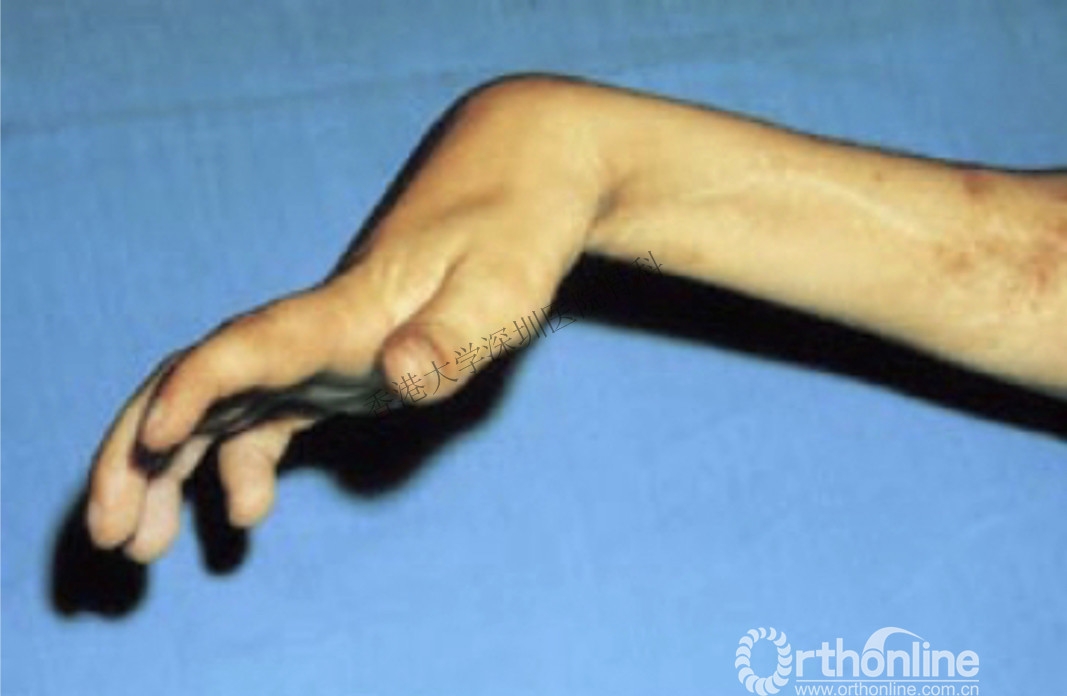 过大(4)肱骨髁上骨折常合并骨筋膜室综合症,导致volkmann缺血性肌挛缩