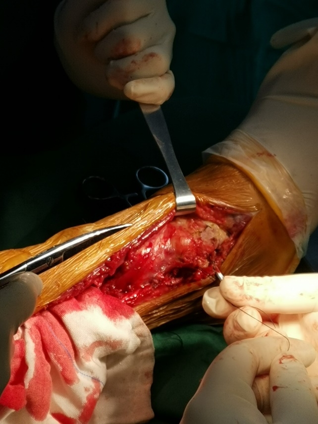 珠江医院关节骨病科林荔军教授团队完成国内首例胫骨远端骨肉瘤切除