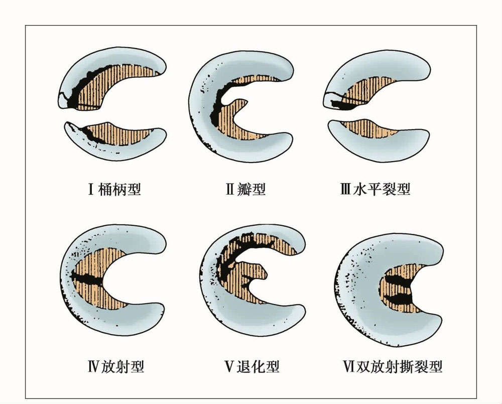 收藏|半月板损伤的常见分型