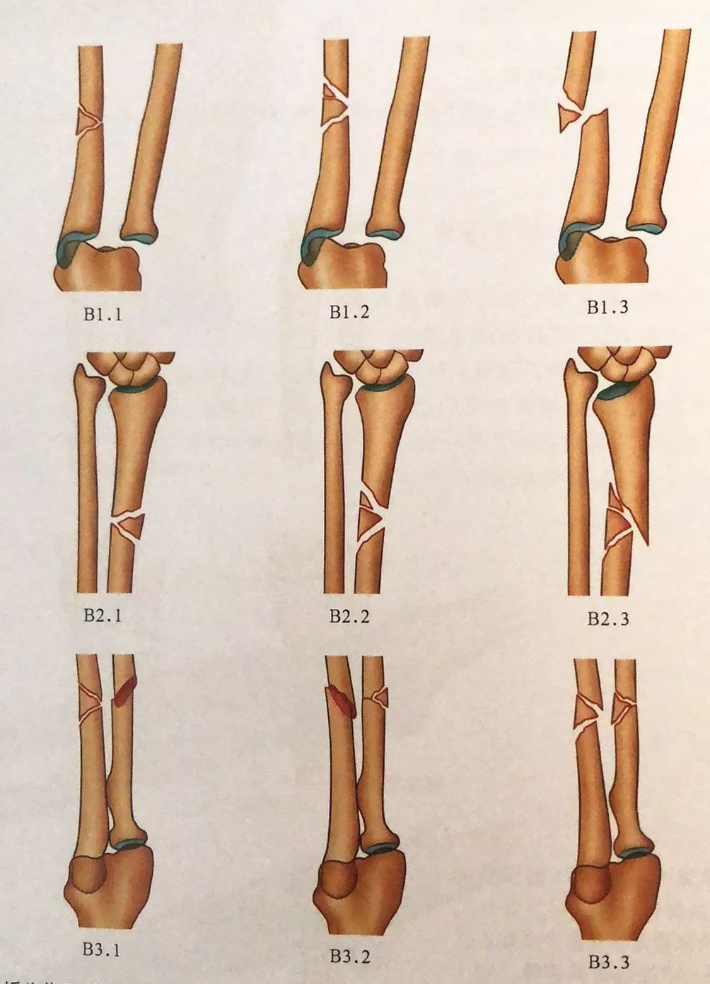 前臂双骨折解剖图片