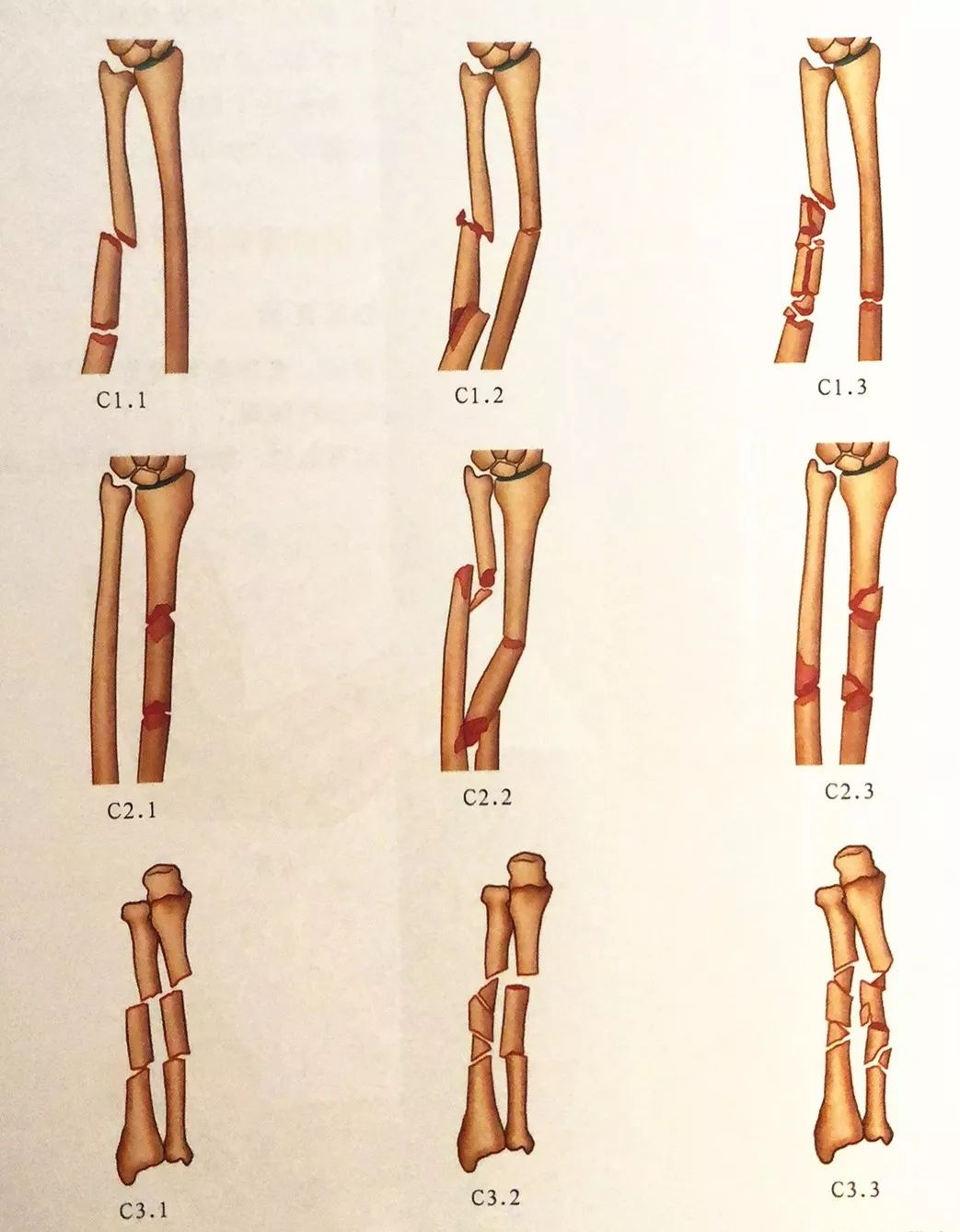 前臂双骨折解剖图片
