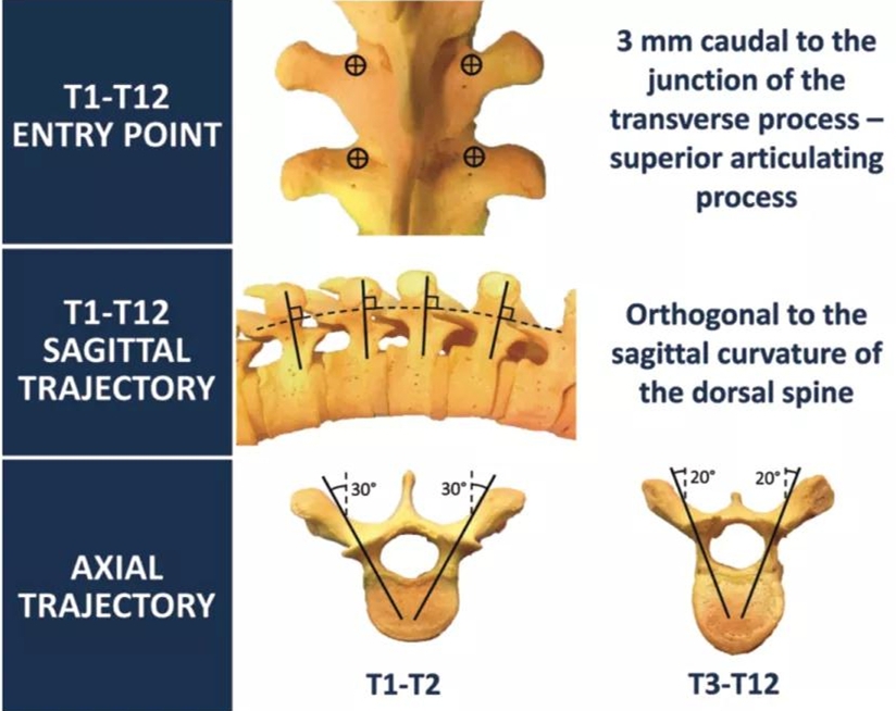 胸椎椎弓根钉进针点图图片