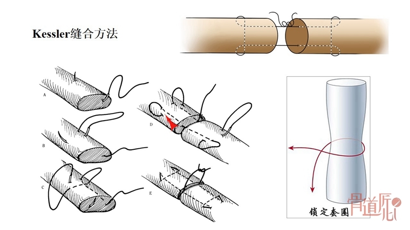 跟腱断裂修复技术中的金线附:bunnell缝合方法相关视频跟腱断裂术后