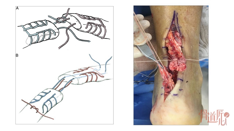 跟腱断裂修复技术中的金线附:bunnell缝合方法相关视频跟腱断裂术后