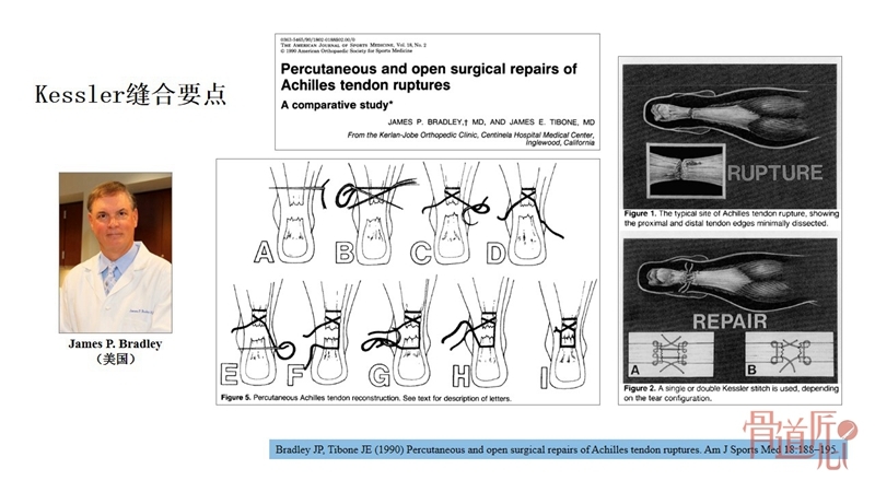跟腱断裂修复技术中的金线附:bunnell缝合方法相关视频跟腱断裂术后
