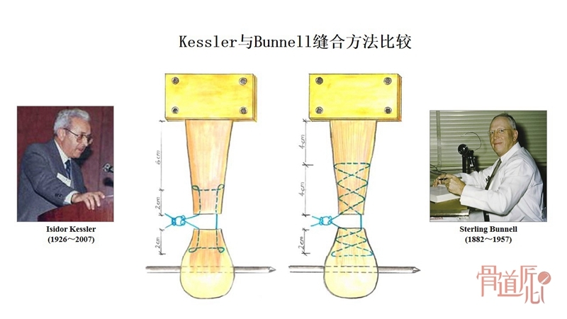 跟腱断裂修复技术中的金线附:bunnell缝合方法相关视频跟腱断裂术后