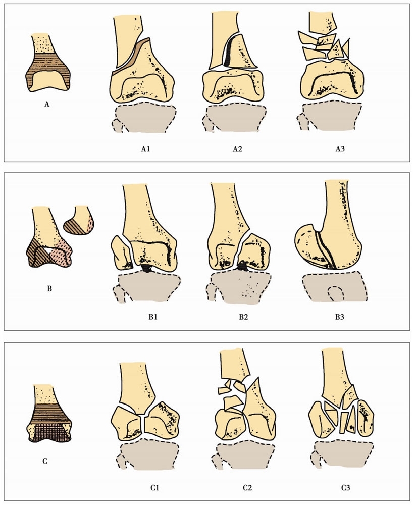股骨骨折分类图片