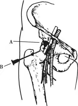 图解肩肘腕髋膝踝六大关节的穿刺进针点 | 骨科在线
