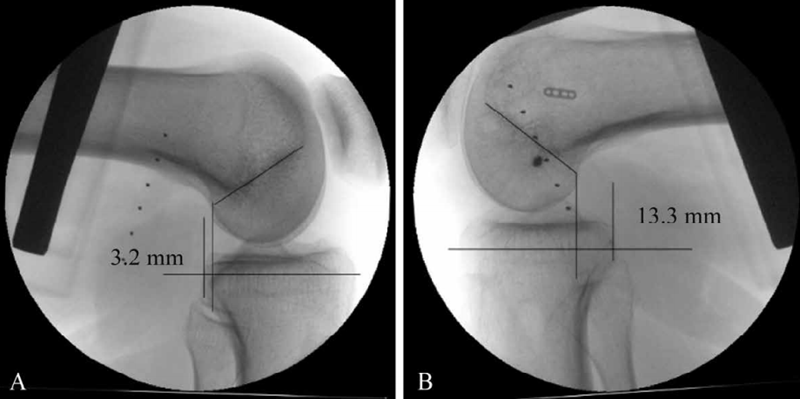 收藏后交叉韧带损伤的诊断