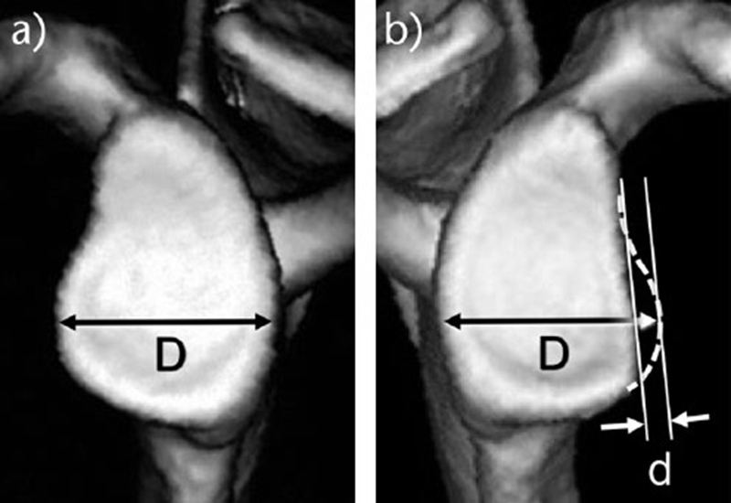肩关节脱位之肩胛盂骨缺损骨性bankart损伤及评估