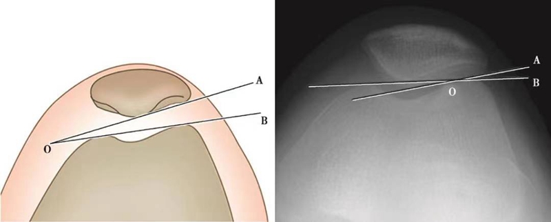 沟角的角平分线与滑车切迹最低点和髌骨正中嵴最低点连线所构成的夹角
